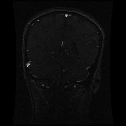 Cavernoma with developmental venous anomaly (Radiopaedia 22470-22507 MRV 52).jpg