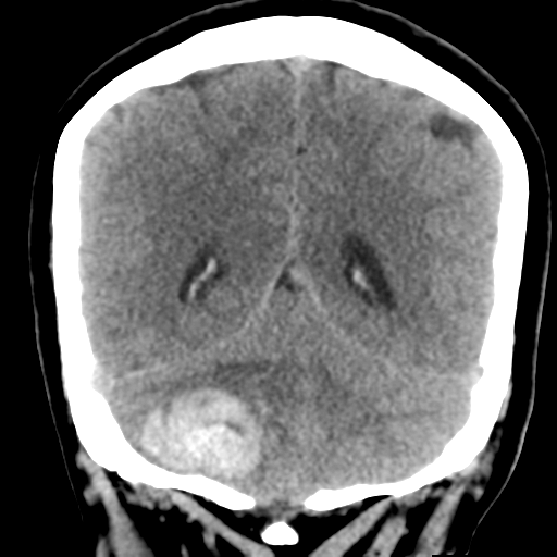 Cavernoma with hemorrhage (Radiopaedia 70755-80931 Coronal non-contrast 44).png