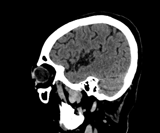 Cavernous hemangioma of the cerebellar falx (Radiopaedia 73025-83723 B 254).jpg