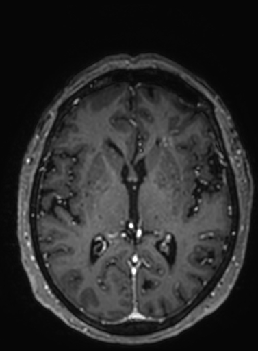 Cavernous hemangioma of the cerebellar falx (Radiopaedia 73025-83724 Axial T1 C+ 163).jpg