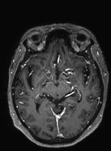 Cavernous hemangioma of the cerebellar falx (Radiopaedia 73025-83724 Axial T1 C+ 191).jpg