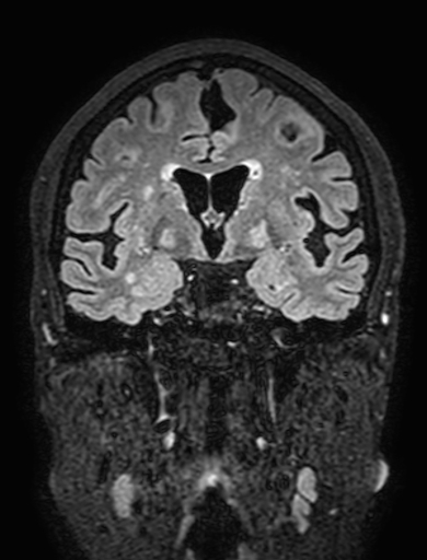 Cavernous hemangioma of the cerebellar falx (Radiopaedia 73025-83724 Coronal FLAIR 158).jpg