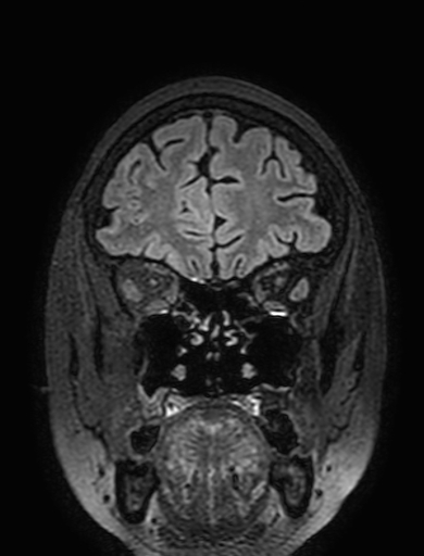 Cavernous hemangioma of the cerebellar falx (Radiopaedia 73025-83724 Coronal FLAIR 68).jpg