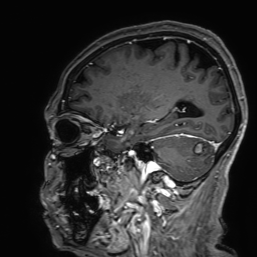 Cavernous hemangioma of the cerebellar falx (Radiopaedia 73025-83724 Sagittal T1 C+ 146).jpg