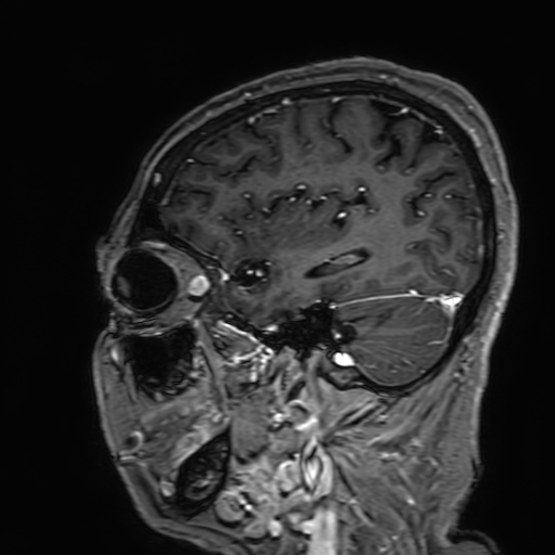 File:Cavernous hemangioma of the cerebellar falx (Radiopaedia 73025-83724 Sagittal T1 C+ 53).jpg