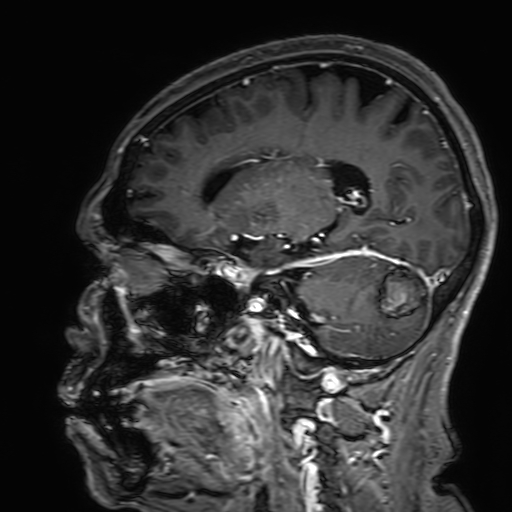 Cavernous hemangioma of the cerebellar falx (Radiopaedia 73025-83724 Sagittal T1 C+ 80).jpg