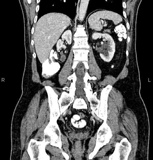 Cecal adenocarcinoma (Radiopaedia 85324-100916 D 45).jpg