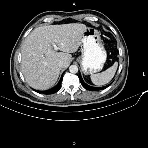 File:Cecal cancer with appendiceal mucocele (Radiopaedia 91080-108651 B 22).jpg