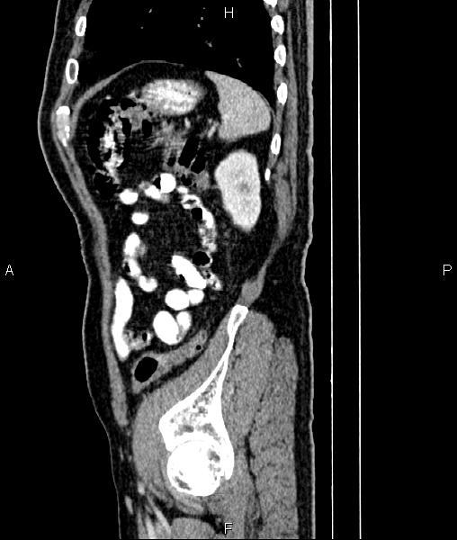 Cecal cancer with appendiceal mucocele (Radiopaedia 91080-108651 E 79).jpg