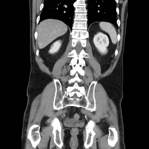 Cecal mass causing appendicitis (Radiopaedia 59207-66531 B 40).jpg