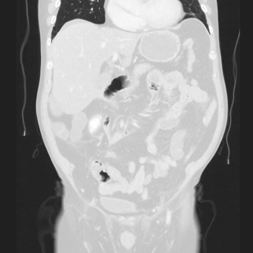 Cecal volvulus (Radiopaedia 75378-86620 Coronal lung window 63).jpg