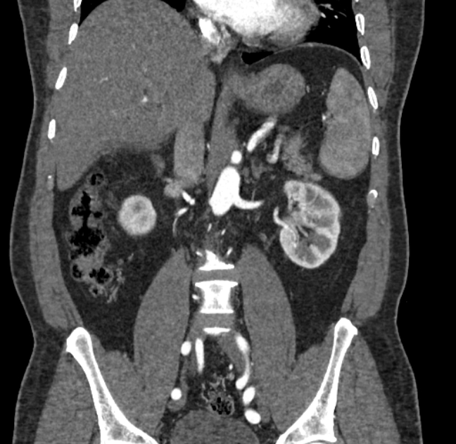Celiac artery dissection (Radiopaedia 52194-58080 C 70).jpg