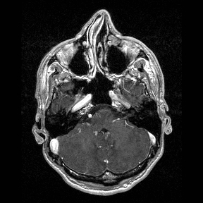 File:Central-variant posterior reversible encephalopathy syndrome (PRES) (Radiopaedia 43880-47358 Axial T1 C+ 30).jpg