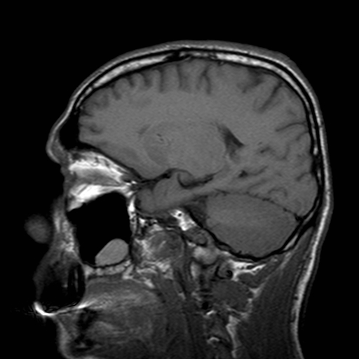 File:Central-variant posterior reversible encephalopathy syndrome (PRES) (Radiopaedia 43880-47358 Sagittal T1 8).jpg