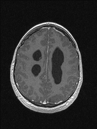 Central neurocytoma (Radiopaedia 56690-63469 Axial T1 C+ 124).jpg