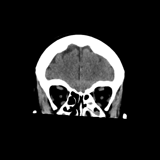File:Central neurocytoma (Radiopaedia 65317-74346 Coronal non-contrast 14).png