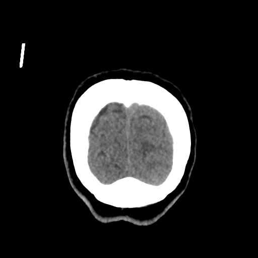 Central neurocytoma (Radiopaedia 65317-74346 Coronal non-contrast 57).png