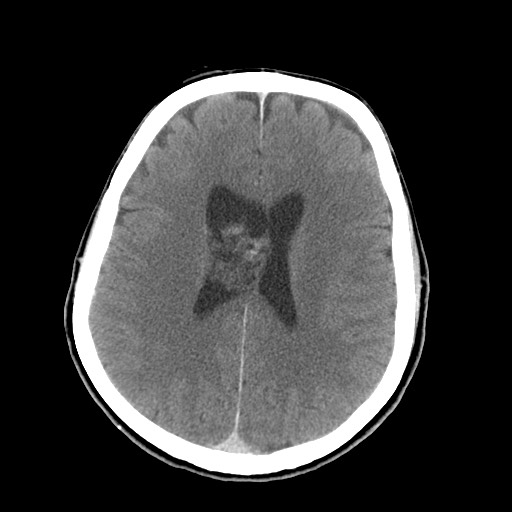 Central neurocytoma (Radiopaedia 68725-78432 Axial C+ 55).jpg
