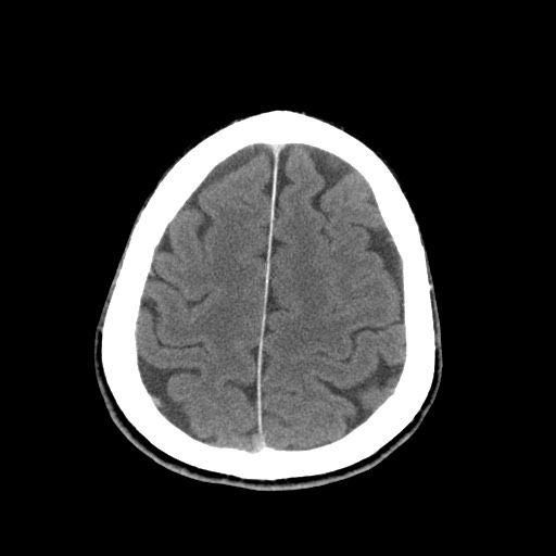 Central neurocytoma (Radiopaedia 68725-78432 Axial C+ 77).jpg