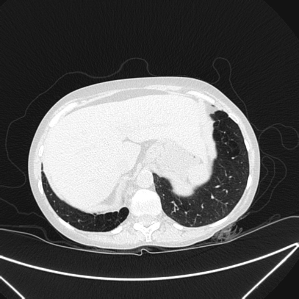 Centrilobular pulmonary emphysema (Radiopaedia 24495-24789 Axial lung window 83).jpg