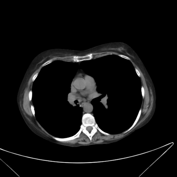 Centrilobular pulmonary emphysema (Radiopaedia 24495-24789 Axial non-contrast 25).jpg