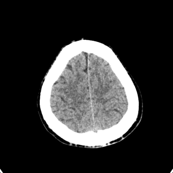 Cerebellar abscess secondary to mastoiditis (Radiopaedia 26284-26412 Axial non-contrast 137).jpg