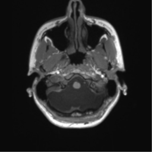Cerebellar agenesis with hypoplastic pons (pontocerebellar hypoplasia) (Radiopaedia 57224-64138 Axial T1 13).png