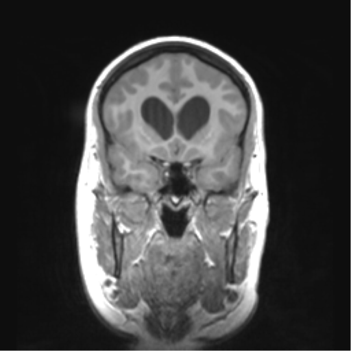 Cerebellar ependymoma complicated by post-operative subdural hematoma (Radiopaedia 83322-97736 Coronal T1 19).png