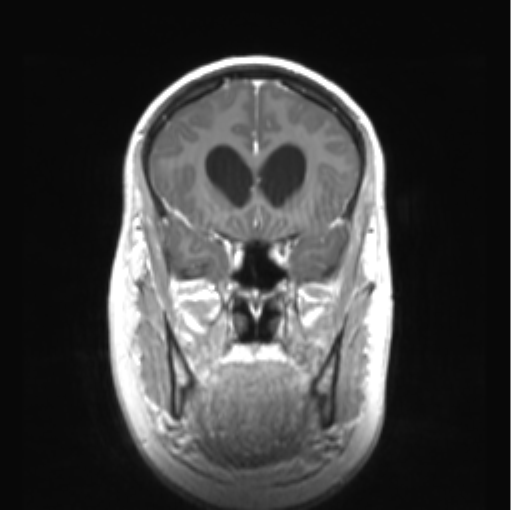 Cerebellar ependymoma complicated by post-operative subdural hematoma (Radiopaedia 83322-97736 Coronal T1 C+ 18).png