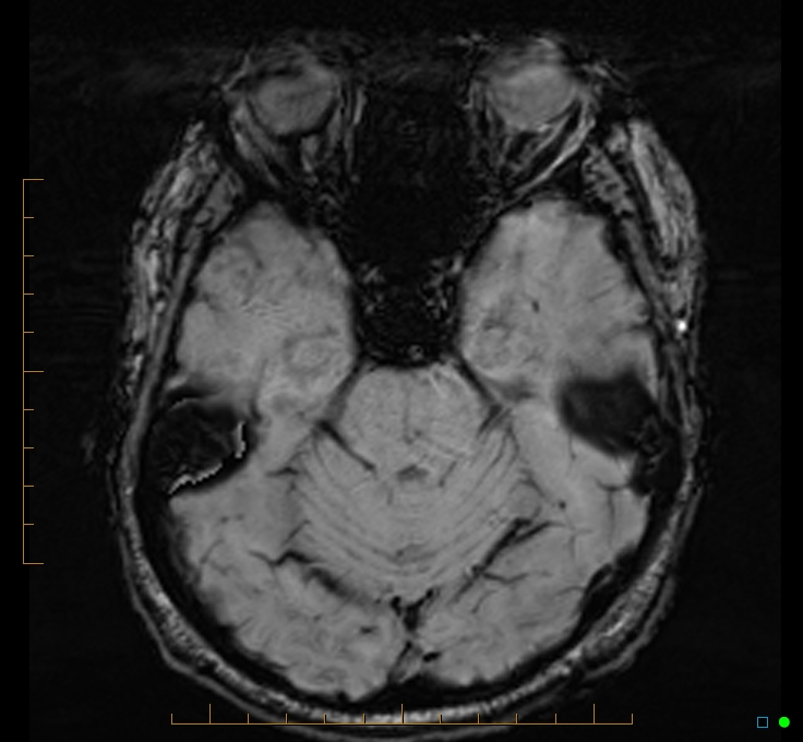Cerebellar gangliocytoma (Radiopaedia 65377-74422 Axial SWI 18).jpg