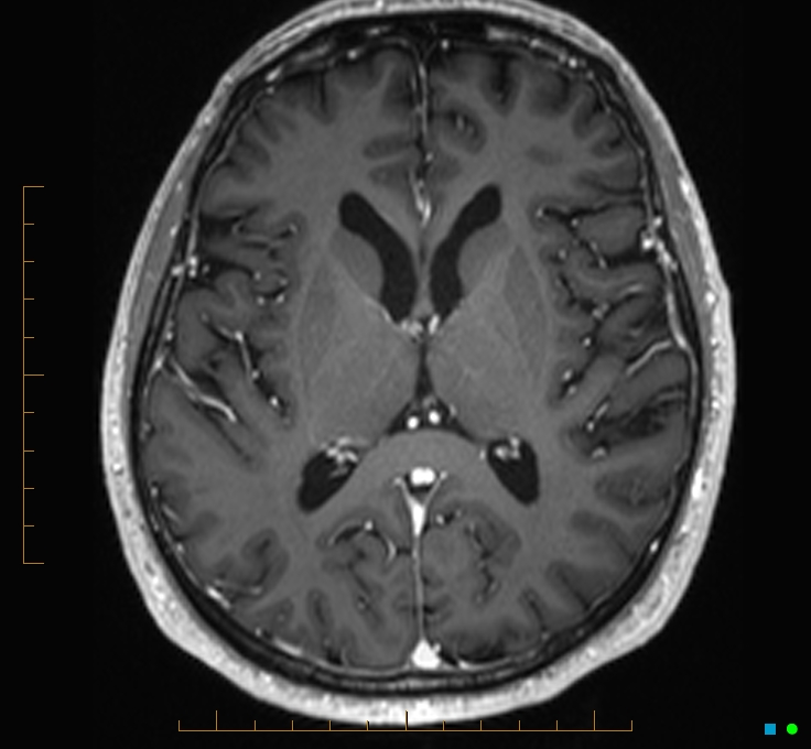 Cerebellar gangliocytoma (Radiopaedia 65377-74422 Axial T1 C+ 70).jpg