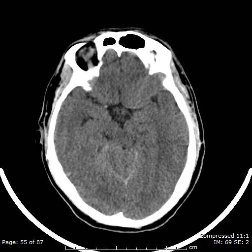 Cerebellar hemangioblastoma (Radiopaedia 52360-58258 Axial non-contrast 55).jpg