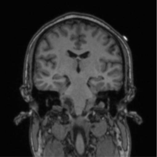 File:Cerebellar hemangioblastomas and pituitary adenoma (Radiopaedia 85490-101176 Coronal T1 44).png