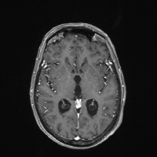 Cerebellar metastases (Radiopaedia 24038-24249 Axial T1 C+ 15).jpg
