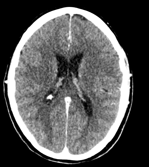 Cerebellar metastases - colorectal adenocarcinoma (Radiopaedia 40947-43652 Axial C+ 35).png