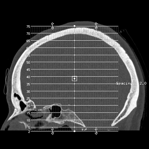 Cerebellar metastasis (cystic appearance) (Radiopaedia 41395-44258 Axial bone window 1).png