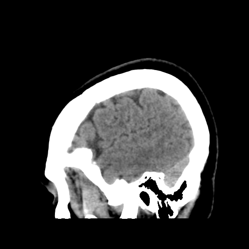 Cerebellar metastasis (cystic appearance) (Radiopaedia 41395-44258 E 46).png