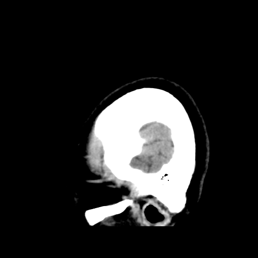 File:Cerebellar metastasis (cystic appearance) (Radiopaedia 41395-44258 E 50).png