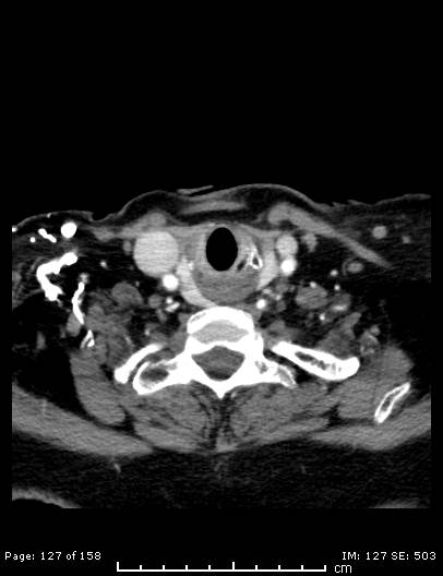 File:Cerebellar strokes due to intracranial giant cell arteritis (Radiopaedia 68799-78510 CT angiogram 127).jpg