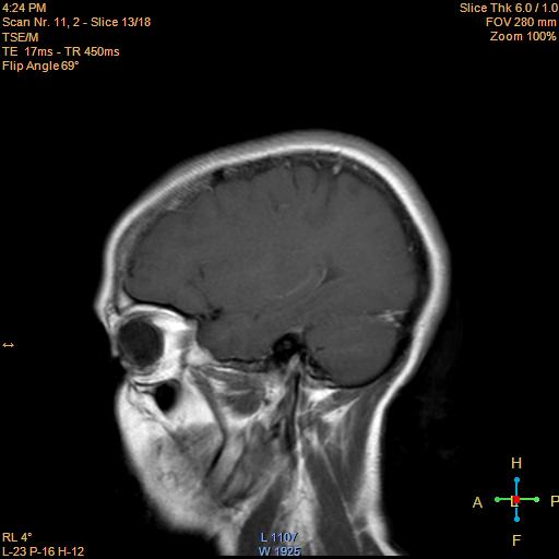 File:Cerebellopontine angle meningioma (Radiopaedia 22488-22525 Sagittal T1 C+ 13).jpg