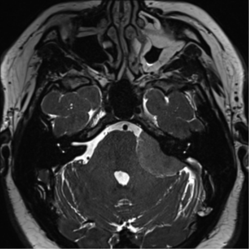 Cerebellopontine angle meningioma (Radiopaedia 48434-53348 Axial T2 Space 63).png