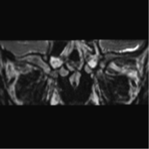 Cerebellopontine angle meningioma (Radiopaedia 48434-53348 Coronal T2 89).png