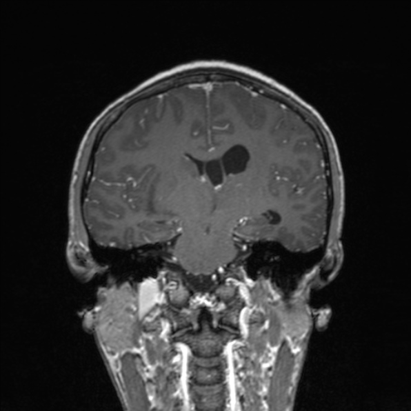 Cerebral abscess (Radiopaedia 24212-24478 Coronal T1 C+ 119).jpg