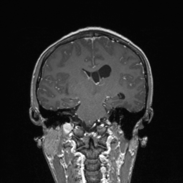 File:Cerebral abscess (Radiopaedia 24212-24478 Coronal T1 C+ 121).jpg