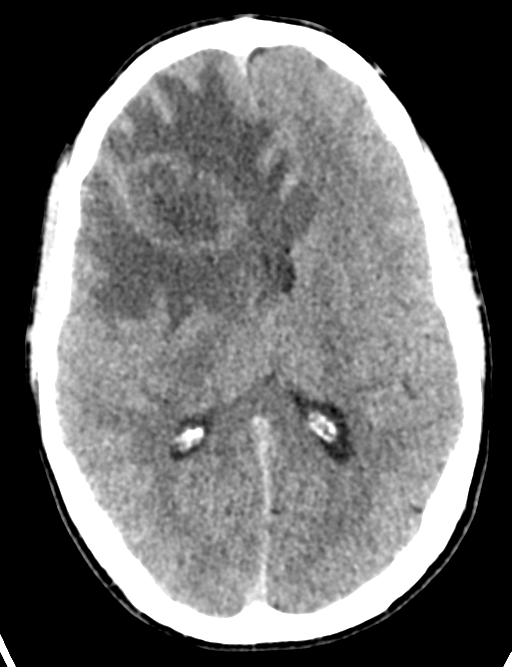 Cerebral abscess (Radiopaedia 60342-68008 Axial non-contrast 29).png