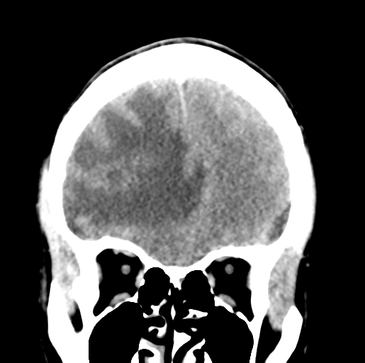 Cerebral abscess (Radiopaedia 60342-68008 Coronal non-contrast 16).png