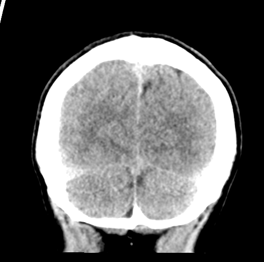 Cerebral abscess (Radiopaedia 60342-68008 Coronal non-contrast 54).png