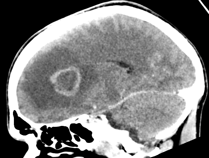 Cerebral abscess (Radiopaedia 60342-68008 Sagittal C+ delayed 30).png