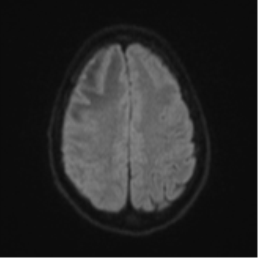 File:Cerebral abscess (Radiopaedia 60342-68009 Axial DWI 63).png