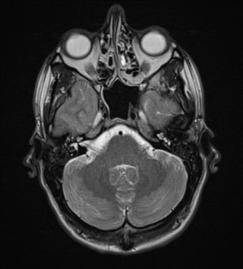 File:Cerebral abscess (Radiopaedia 60342-68009 Axial T2 7).png
